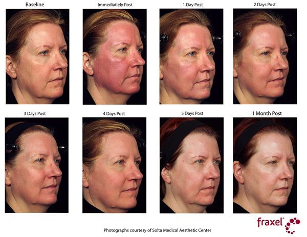 Fraxel post treatment pictures