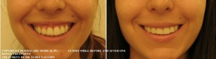 gummy smile before and after botox correction