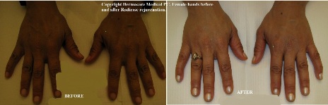 Hands rejuvenation