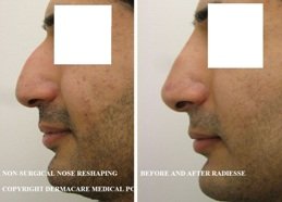 non-surgical nose job