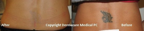 back laser tattoo removal