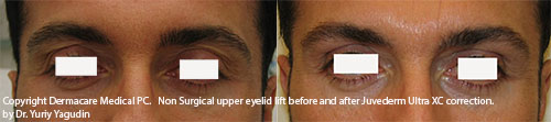 eyebrow lift