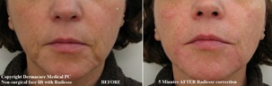 non-surgical face lift