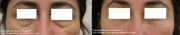 Dark circles under eyes before and after