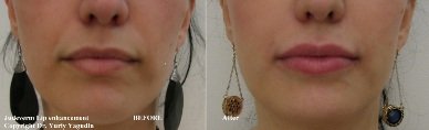 lips before and after juvederm