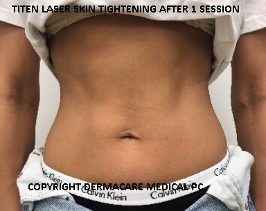Titan laser skin tightening after