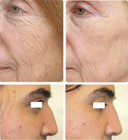 Before and After