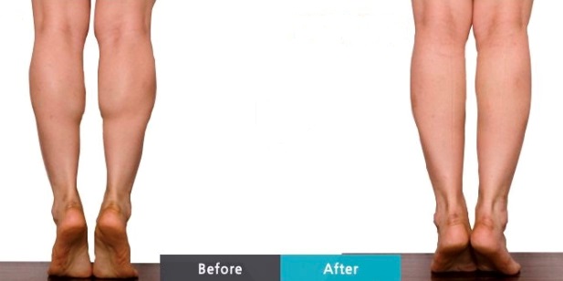 botox calf reduction