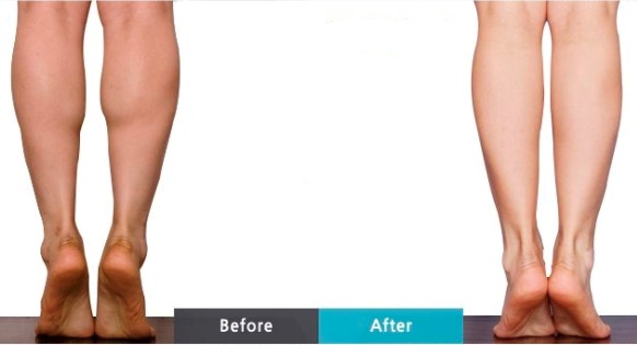 botox calves reduction