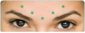 Dysport Injections