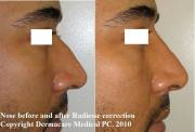 non-surgical male nose job