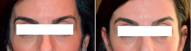 temple augmentation before and after