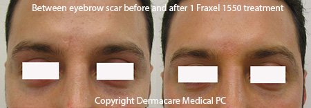 Fraxel scar treatment