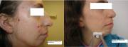 Before and After 3 PDT Sessions