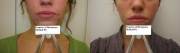 Before and After 1 PDT Session