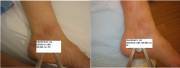Before and After one Laser Vein Treatment