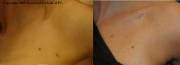 axillar mole before after