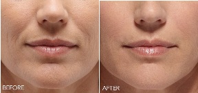 belotero balance before and after