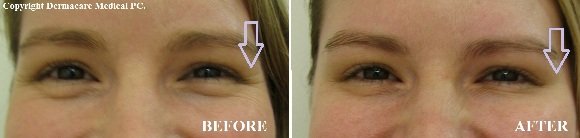 botox crows feet