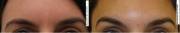 eyebrow lift
