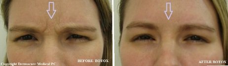 botox glabellar