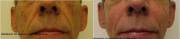 Cheek Augmentation with Radiesse before and after