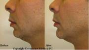 Chin augmentation