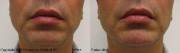 Chin augmentation