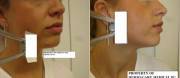 Chin Mole Removal Before After
