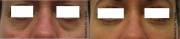 Dark under eye circles before and after Juvederm