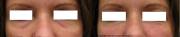 Tear trough correction 5 mins post procedure