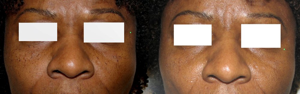 Dermatosis papulosa nigra