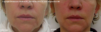 non-surgical face lift