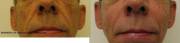 Facial liopatrophy before and after Radiesse correction 4