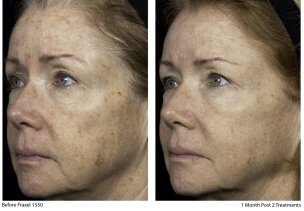 fraxel age spot removal
