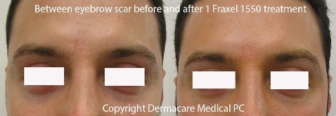 fraxel scar removal