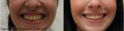 Gummy smile corrected with Botox
