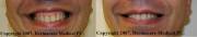 Gummy Smile Before and After Botox Treatment