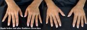 Radiesse hand rejuvenation