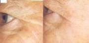 58 yr old male, 14 days post treatment