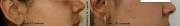 Before and After 2 IPL sessions