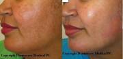 Before and After 1 IPL session