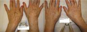 Before and After 2 IPL sessions