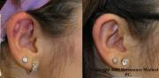 Keloid Before and After Radiosurgery