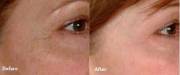 Laser Genesis before and after
