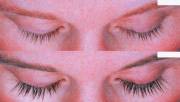 Latisse eyelash extension