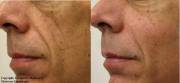 Before and After Radiesse Correction