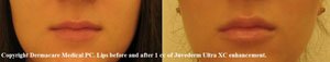 lips before and after Juvederm XC ultra