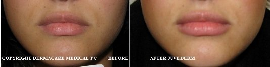 lips before and after