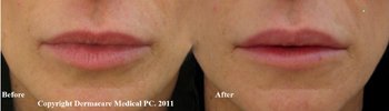 lip augmentation before and after